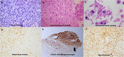 Immunopathology of Tumefactive Demyelinating Lesions-From Idiopathic to Drug-Related Cases